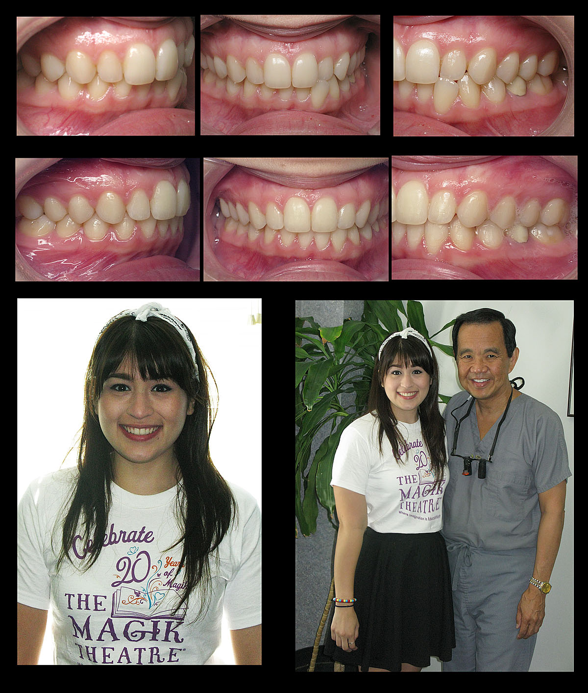 six month braces patient josey